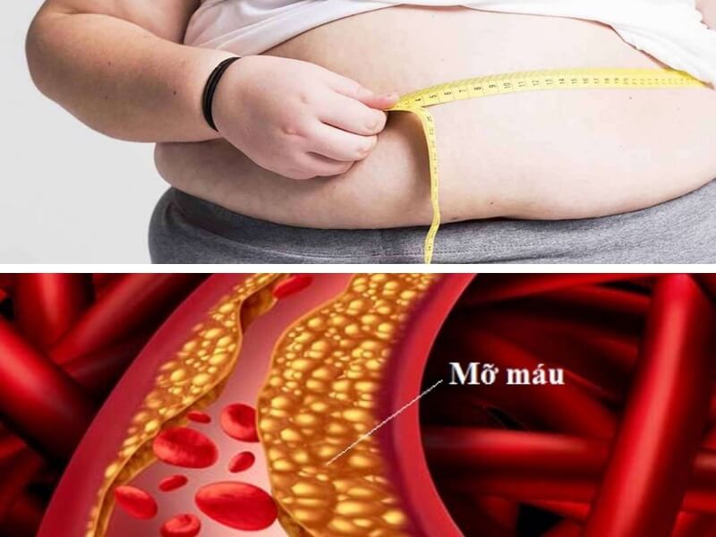 Người béo phì rất dễ bị máu nhiễm mỡ
